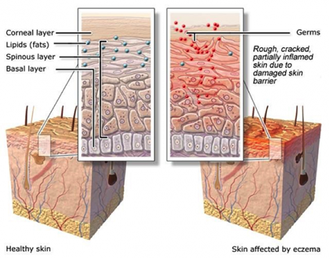 What is eczema