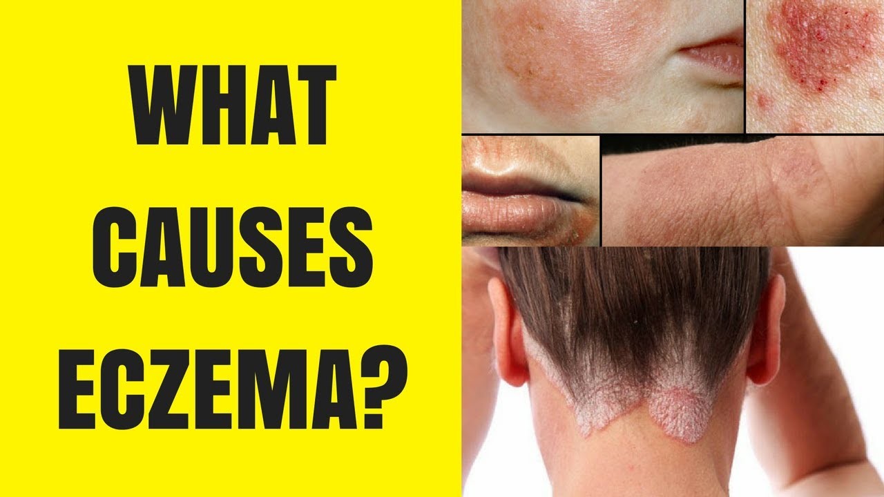 Causes eczema
